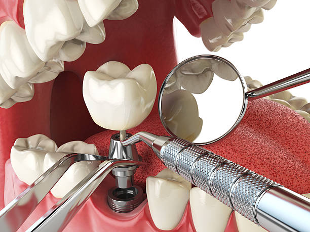 Best Emergency Wisdom Tooth Extraction in Georgiana, AL